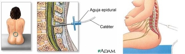 anestesia-epidural
